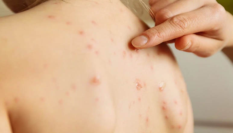 Skin Infection